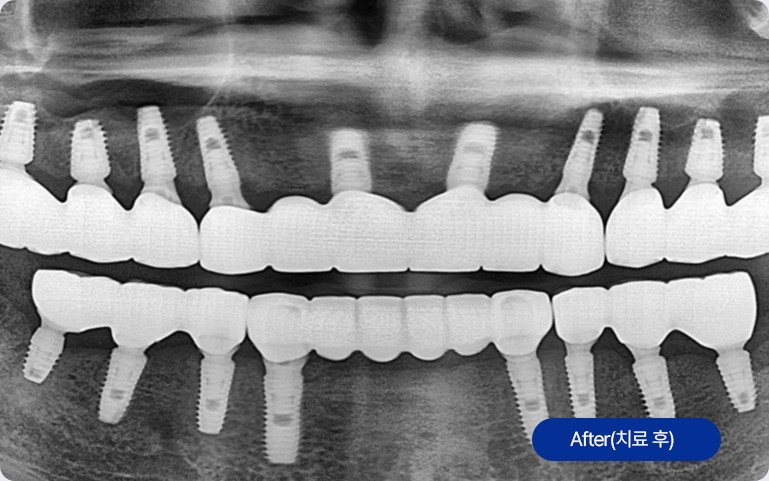 치아교정 치료 후 X-ray