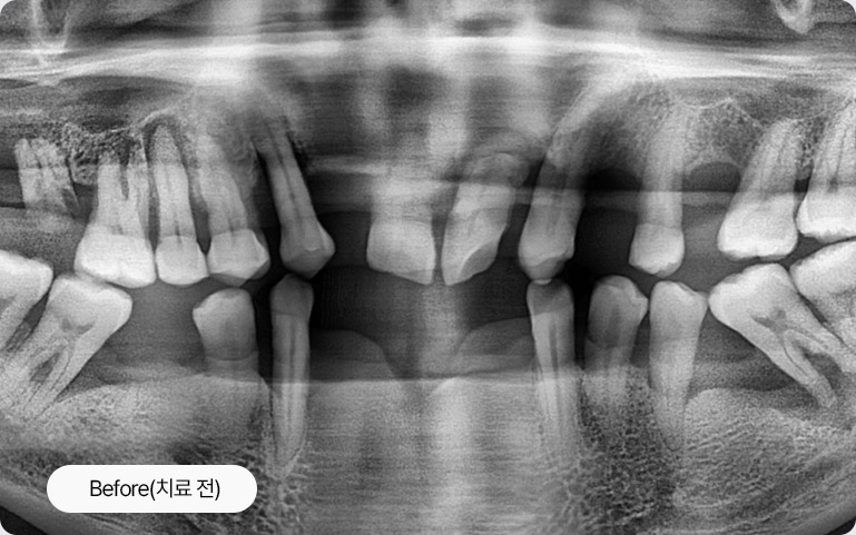 치아교정 치료 전 X-ray